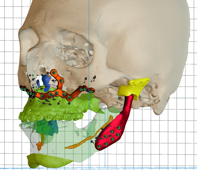 3D-моделирование в лечении челюстно-лицевых патологий