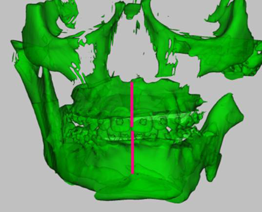 3D-моделирование в лечении челюстно-лицевых патологий