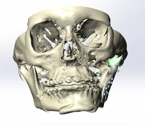 3D-моделирование в лечении челюстно-лицевых патологий