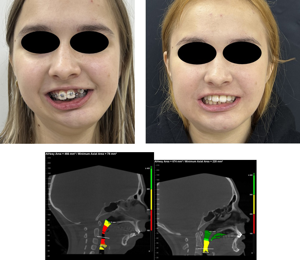 3D-моделирование в лечении челюстно-лицевых патологий
