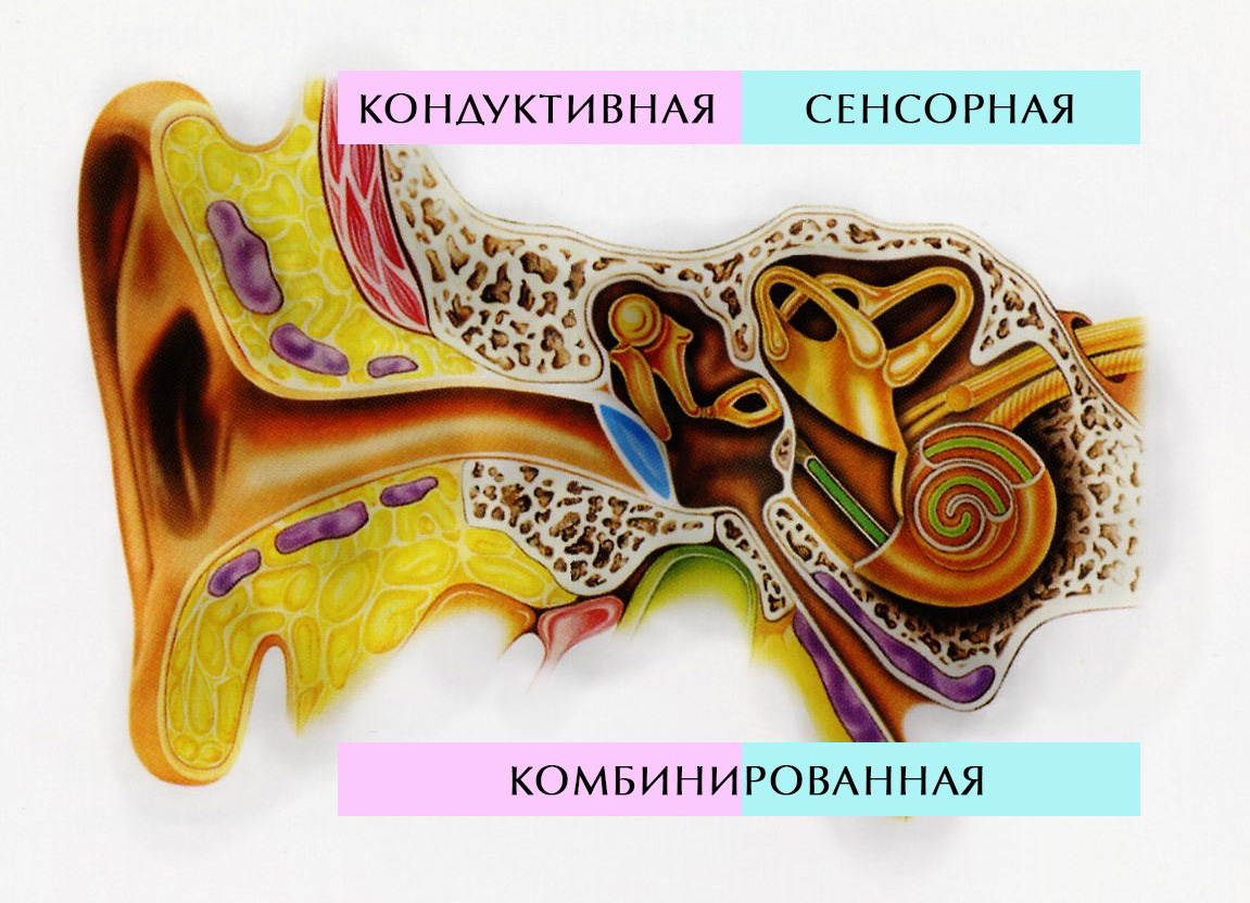 Кондуктивная и сенсоневральная тугоухость