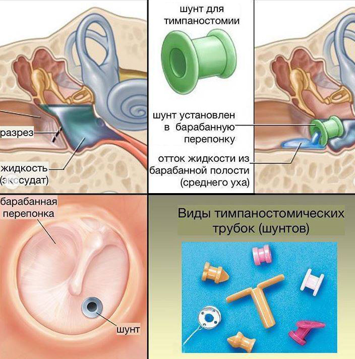 Этапы проведения тимпаностомии и виды шунтов