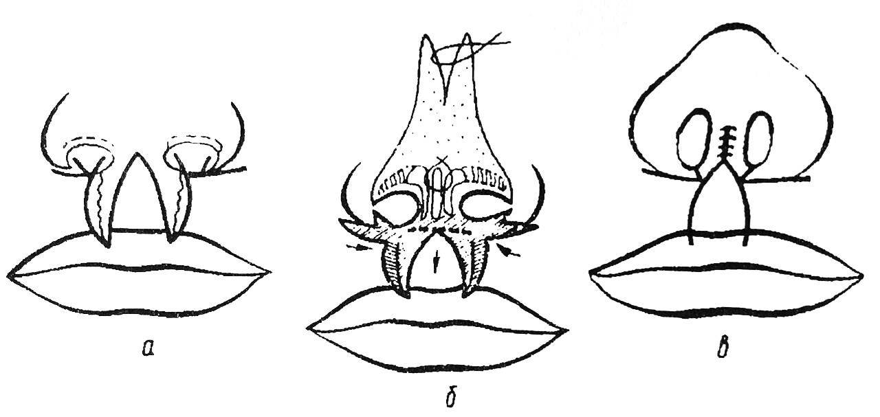 Методы коррекции губы и носа, предложенные Козиным И.А. и Виссарионовым В.А.